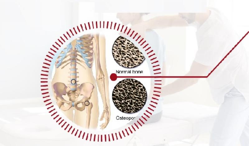 Giornata Mondiale dell'Osteoporosi